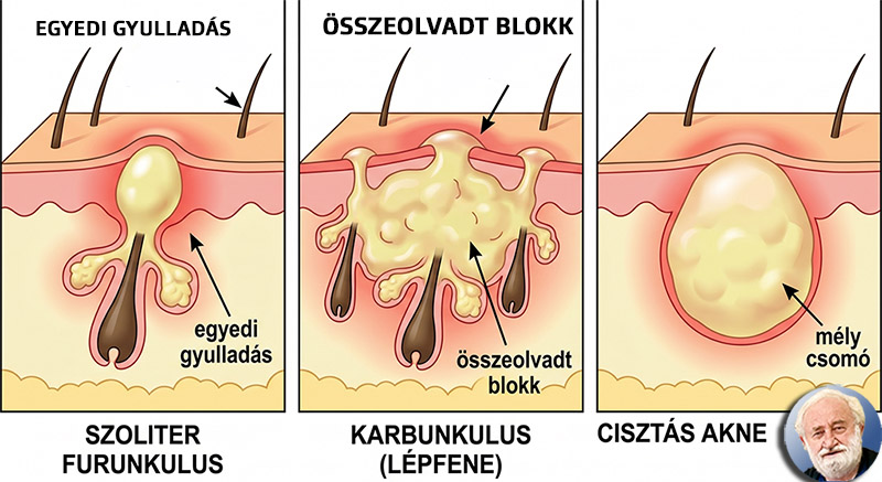 A furunkulusnak több fajtája van? Igen. Be is mutatjuk a típusait.
