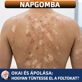 Napgomba okai és ápolása: Hogyan tüntesse el a foltokat?