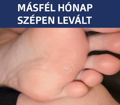 Talpon lévő szemölcs Másfél hónapos Kerador-X krém ápolás után szépen el is vált