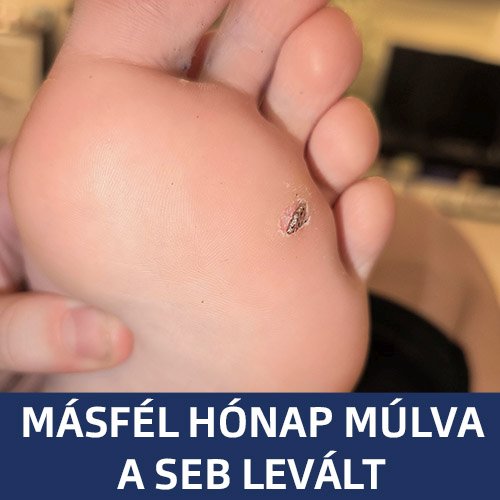 Talpon lévő szemölcs Másfél hónapos Kerador-X ápolás után elkezdett leválni