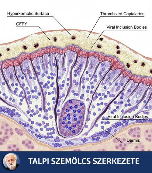 Talpi szemölcs szerkezete | KÉK Lukács esettanulmány