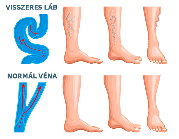 Normál véna vs. visszeres véna
